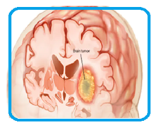 Brain Tumor representation